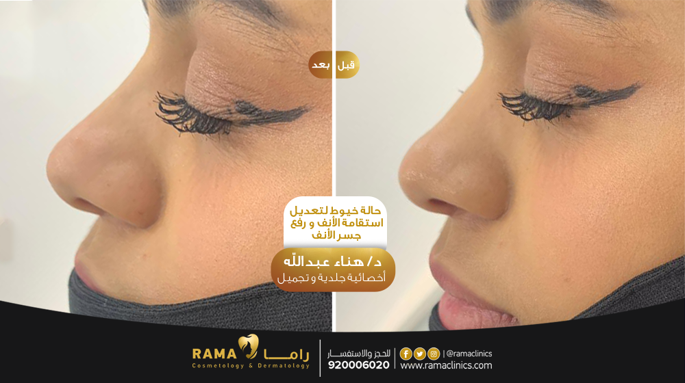 قبل العلاج