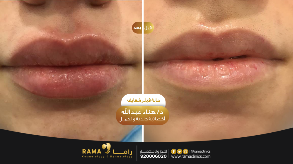 قبل العلاج